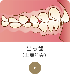 出っ歯（上顎前突） 