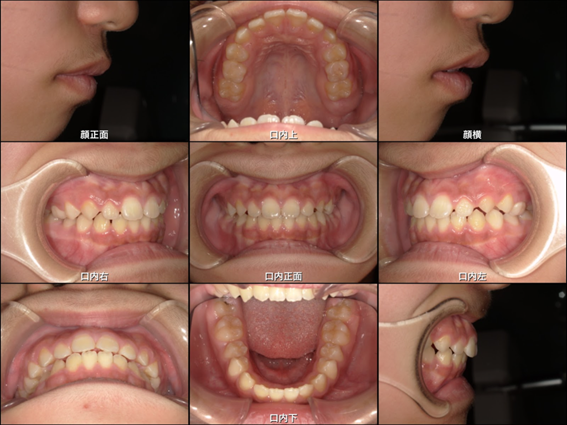 下の歯がねじれて生えている