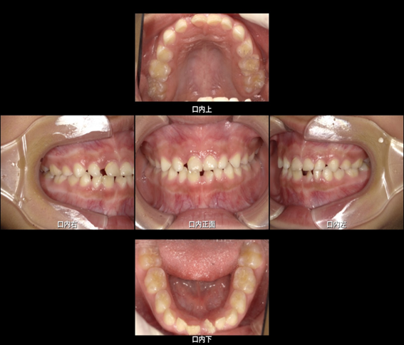 下の歯がねじれて生えている