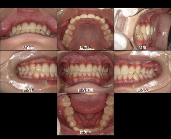反対咬合、受け口、しゃくれ